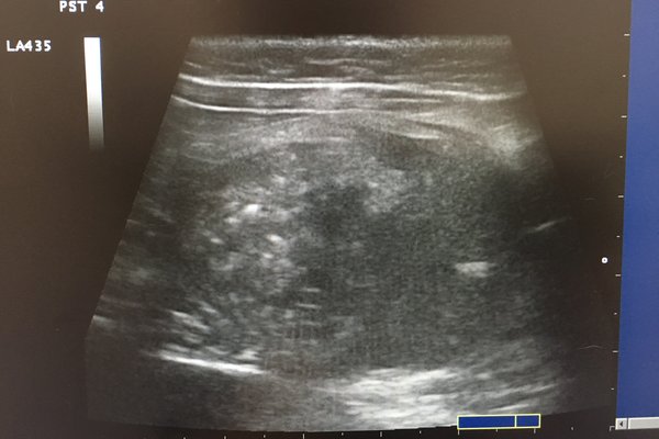 Ultrasound of the Bladder