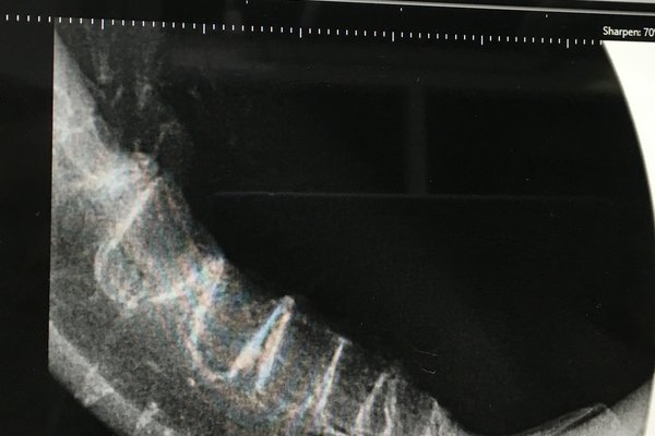 Dental X rays - After