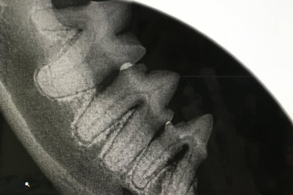 Dental X rays - Before