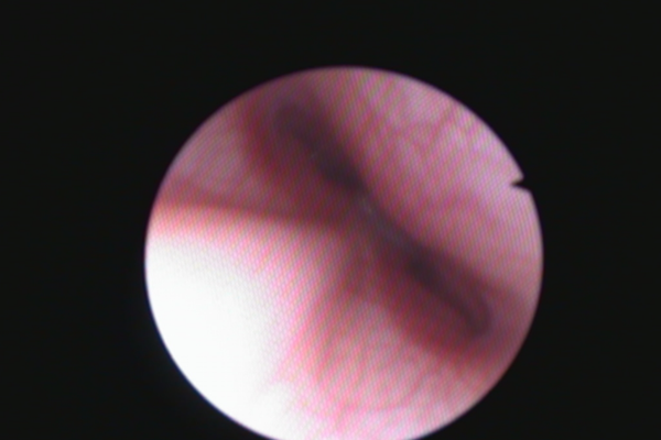 Endoscopy Picture - Nasal Cavity