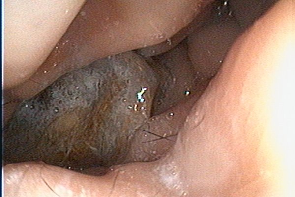 Endoscopy Photo 2