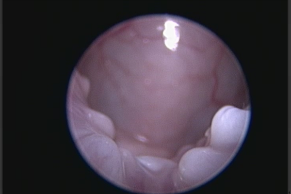 Endoscopy Picture - Soft Palate
